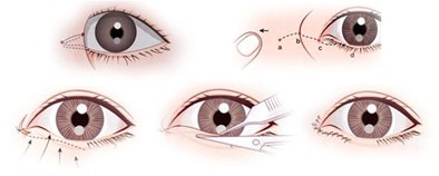 擔心開眼角傷害大?帶你了解“真相(xiàng)”!